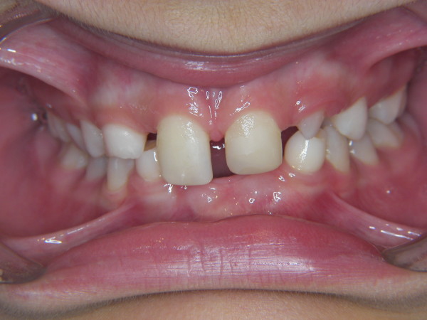 Polyagénésies : dents qui n'existent pas